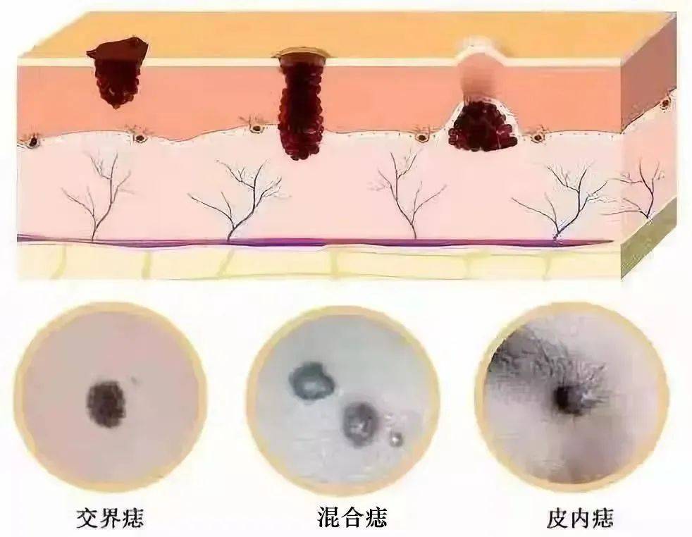 沈阳肤康为您解析：伊藤痣的科学应对与治愈之道！(图1)